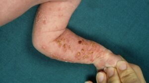 Un bambino con una mano sollevata mostra la pelle con difetti cutanei cromatici Lunghia è stata trattata con NailPersona per esaltare la cura della pelle come parte del corpo