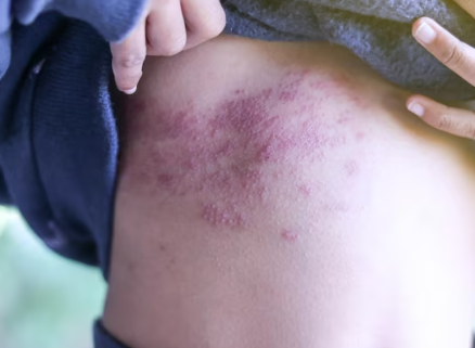 Lupus Eritematoso Neonatale Una Patologia Medica