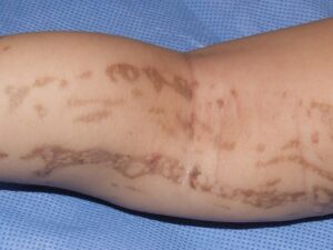 Un bambino con i difetti cutanei cromatici sulla pelle del braccio una storia di superamento che viene raccontata attraverso un tatuaggio sulla parte del corpo che meglio ne rappresenta lesperienza