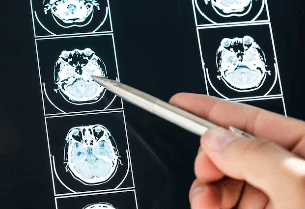 Radiografie del cervello su cui è puntata una penna tenuta dalla mano di un medico