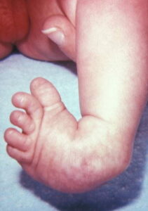 Un bambino con una malformazione ulnare pedale alza il suo dito del piede, mostrando la parte del corpo che ha un naso disegnato sopra una NosePersona!