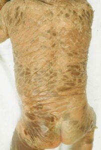 Una persona affetta da grave malformazione congenita che porta ad una fusione di braccio e schiena, conosciuta come ArmPelle Una parte del corpo straordinariamente unica