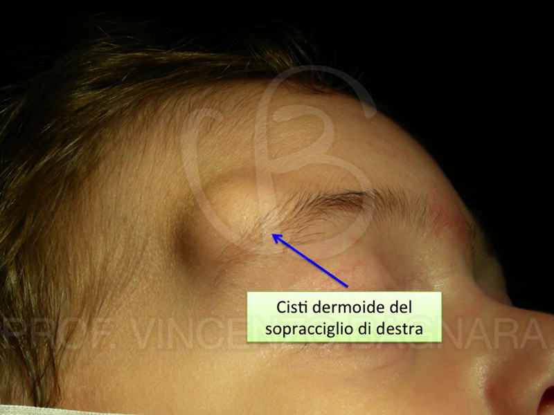 Cisti Dermoidi Facciali Di cosa si tratta?