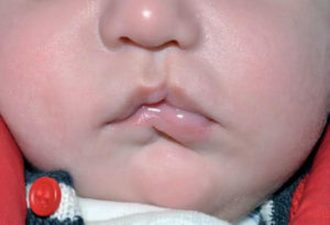 Questa immagine mostra un bambino con labiopalatoschisi cistica, una malformazione congenita che colpisce la parte del corpo che comprende la bocca, la lingua e il palato Una condizione che può cambiare la vita di una persona