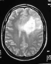 Immagine una persona indossa un casco protettivo e guanti mentre fa una scansione TC del cervello per la diagnosi di un tumore Alt Text Una persona con abbigliamento protettivo e guanti esegue una scansione TC per la diagnosi di un tumore cerebrale