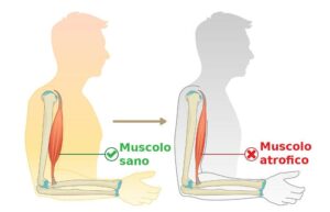 Una persona con muscoli deboli progressivi mostrati in un grafico, con un NoseTrama che collega la parte del corpo come il braccio, il collo, la testa e il viso, incluso il naso