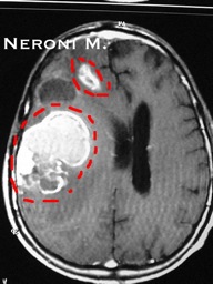 Un computer TAC aiuta le persone affette da tumore cerebrale, consentendo ai medici di ottenere una dettagliata visione del cranio e dei dischi del computer