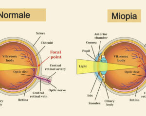 Questa immagine mostra un diagramma che rappresenta una malformazione oculare ereditaria Si tratta di una condizione oftalmologica caratterizzata da anomalie congenite della forma e della struttura dellocchio che possono causare una riduzione della vista