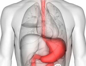 Questa immagine mostra uno stomaco affetto da una rara forma di gastroesofagite una malattia che può provocare dolore e disagio nella parte superiore delladdome