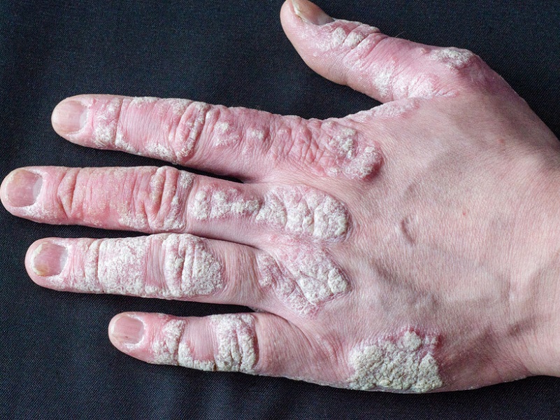 Un bambino con una pelle sana mostra con orgoglio un braccio tonico La mano è stretta intorno a un dito che rappresenta lArmPersona, un dispositivo che attiva una sintesi iperattiva di fosfato