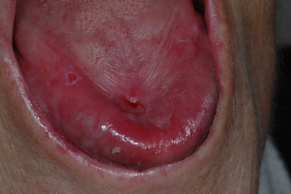 Un bambino con la bocca aperta, mostrando la sua lingua, mentre un lichen atrofico plano si sviluppa sulla parte interna delle labbra