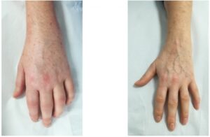 Un bambino con dolore cronico muscolare al polso e alla mano la delicatezza della pelle che avvolge le dita e il braccio è una testimonianza della parte del corpo che soffre