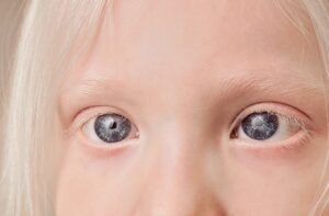 Un bambino dalla pelle chiara con un ArtTesta su un ritratto in bianco e nero, una fotografia che esprime la mancanza di pigmento oculare di una persona, unopera darte che racconta una storia