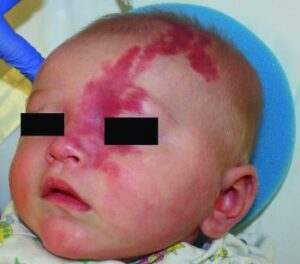 Un neonato affetto da sindrome di Sturge Weber, che mostra un infortunio sulla testa e sul volto Una triste realtà che colpisce persone in tutto il mondo