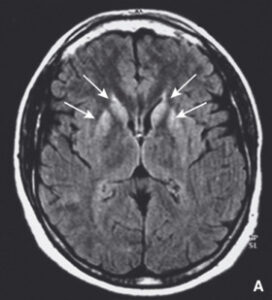 Una foto di una Tomografia Computerizzata, di una Lampadina e di un Lampadario, per illustrare la complessità della diagnosi di una malattia genetica prionica