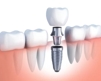 servizio di implantologia dentistica