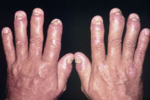 Una persona con linfiammazione articolare al dito, mostrando la pelle intorno allunghia come parte del corpo