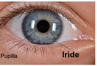 Una fotografia di un occhio con uninfiammazione delliride e un paio di lenti a contatto, che mostra come le lenti a contatto possano avere effetti nocivi se non indossate correttamente