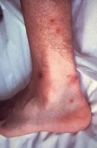 Un bambino con linfiammazione diffusa asettica che colpisce la parte del corpo dalla testa al ginocchio La sua pelle, viso e collo mostrano segni di infiammazione, con unaggravazione maggiore intorno al ginocchio e alla caviglia