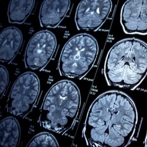 Questa immagine mostra una persona sottoposta a Tac per diagnosticare uninfiammazione cerebrale epilettica La scansione aiuterà a identificare i possibili fattori scatenanti e a scegliere la strategia terapeutica più efficace