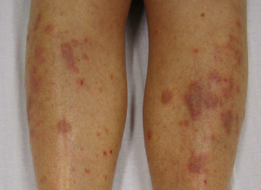 Una persona con una dermatosi autoimmune cronica che colpisce la sua pelle, in particolare intorno al ginocchio una storia di sofferenza, ma anche di resilienza
