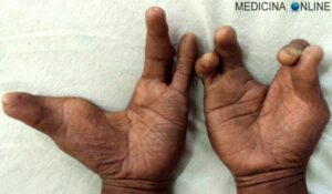 Un bambino con una mano dallaspetto anomalo, mostrando un dito in più al polso La sua pelle è visibilmente scoperta a causa della calvizie Una parte del corpo che suscita curiosità
