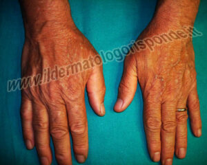 Una persona colpita da una distrofia cutanea ereditaria, che mostra la mano con la pelle del dito che si sfalda, diventando più sottile, è una situazione che può colpire qualsiasi parte del corpo