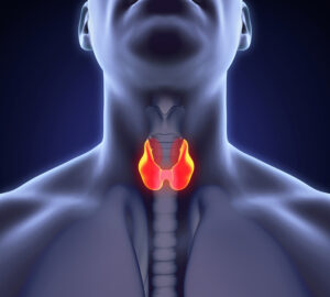 Una donna adulta con una testa e un viso con una gola che mostra segni di iperattività della tiroide Unimmagine che rappresenta le conseguenze di una condizione medica che può avere un impatto significativo sulla vita di una persona