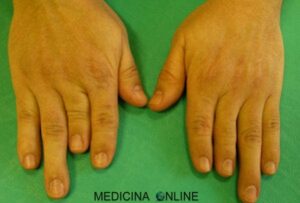 Un bambino con lintelletto limitato che alza un dito della sua mano come se fosse una gamba Un simpatico gesto che rappresenta la parte del corpo più piccola, il dito del piede