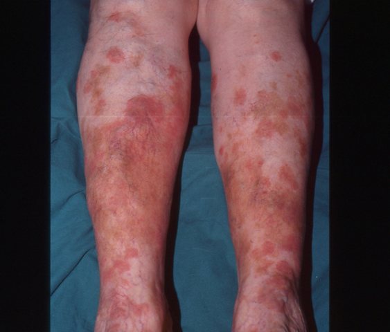 Una persona che soffre di una malattia cutanea autoimmune la sua pelle, una parte importante del suo corpo, è interessata, in questo caso al ginocchio