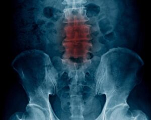 Raffigurata nellimmagine è una persona con una malformazione spinale, che è stata sottoposta ad esami diagnostici come la Risonanza Magnetica RM, la Tomografia Computerizzata TC e i Raggi X RX