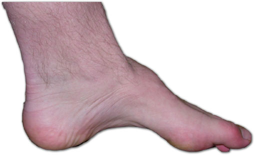 Un bambino soffre di neuropatia ereditaria conosciuta come FootAnkle, una malattia che colpisce la parte inferiore del corpo, come il piede e il tallone Una persona che soffre di questa condizione ha bisogno di una particolare cura e assistenza