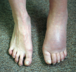 Una persona afflitta da dolore cronico al muscolo della caviglia, ricordandoci che anche le piccole parti del nostro corpo possono soffrire