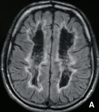 Questa Risonanza Magnetica mostra un Canguro, un Mammifero affetto da Distrofia Cerebrale Ereditaria Una malattia che colpisce sia umani che animali