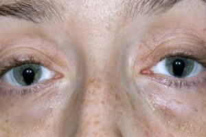 Una faccia riconoscibile, che mostra una malformazione oculare ereditaria e una pelle ricoperta di piccole lentiggini Una testa che ricorda a tutti che le malattie genetiche possono colpire chiunque