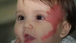 Questa immagine mostra un neonato con una testa e un viso che soffrono di malattia vascolare cerebrale Il volto del bambino trasmette forza e speranza per una vita piena di sani sogni