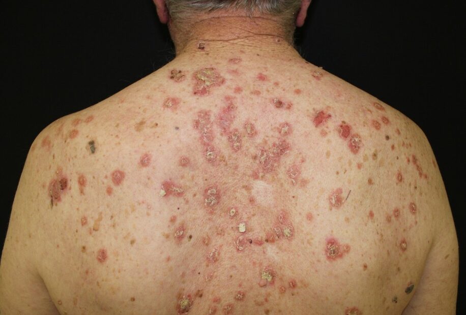 La dermatite bollosa recidivante non può limitare la vita di una persona grazie a LifePersona, la pelle può ritrovare la sua vitalità