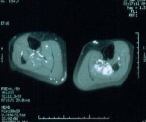 Immagine di un tumore benigno cutaneo diagnosticato con Tomografia Computerizzata la scansione permette di identificare con precisione le caratteristiche del tumore