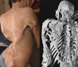 In questa fotografia, un uomo adulto con distrofia muscolare è visto di schiena, con un tronco e le spalle ben evidenti Una raffigurazione che mostra come la malattia colpisca anche le persone più forti