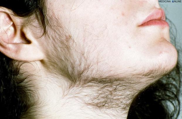 Uomo adulto con peli in eccesso congenito, osservato da vicino con HairTesta vediamo più da vicino il suo viso, collo e mascella con la sua chioma di capelli