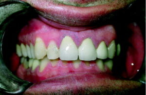 Una persona con una malformazione genetica ereditaria che le causa anomalie nella forma della bocca e dei denti
