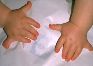 Un bambino con unanomalia delle dita si sottopone a un massaggio al polso per aiutare a ridurre la calvizie una parte importante del corpo umano che richiede cure speciali