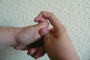 Una foto di un bambino con una malformazione cranica congenita che riceve un massaggio al polso con la mano di un adulto Una parte del corpo che mostra la pelle e lunghia di un dito chiamato NailDito