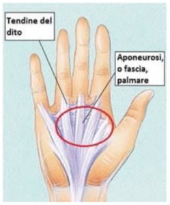 Una NailPersona mostra un tumore benigno cutaneo sulla sua mano, intorno al dito e allunghia Una vista ravvicinata di come prevenire e curare le malattie della pelle