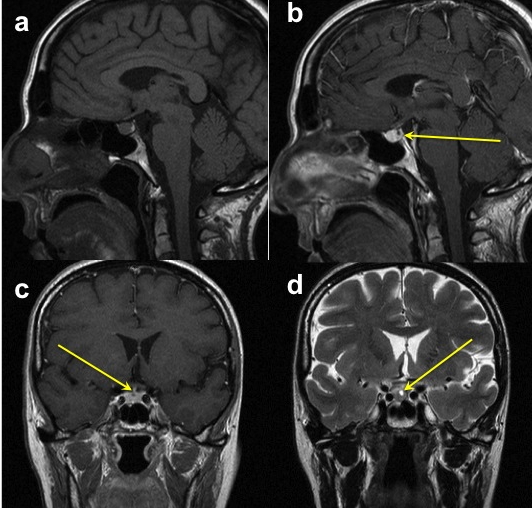 Patologia delle Cisti Dermoidi ed Epidermoidi dell Ipofisi
