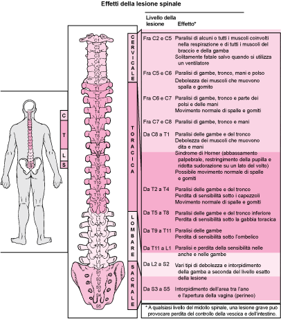 Disordine della connessione tra cervello e midollo spinale