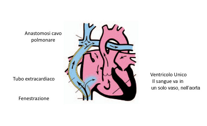 Isolata Discrepanza Ventricolo-Arteriosa