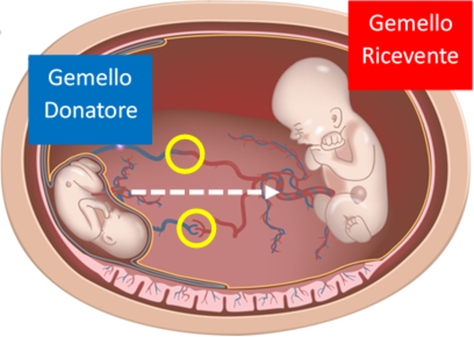 Disgenesia Renale da Trasfusione Gemello-Gemello