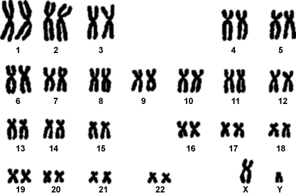 Distrofia Materna del Cromosoma X