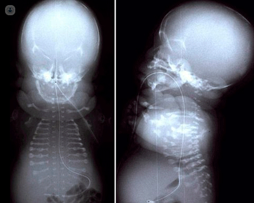 Platispondilia scheletrica letale di tipo Torrance: una patologia mortale